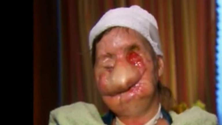 Woman attacked by chimp reveals face on Oprah