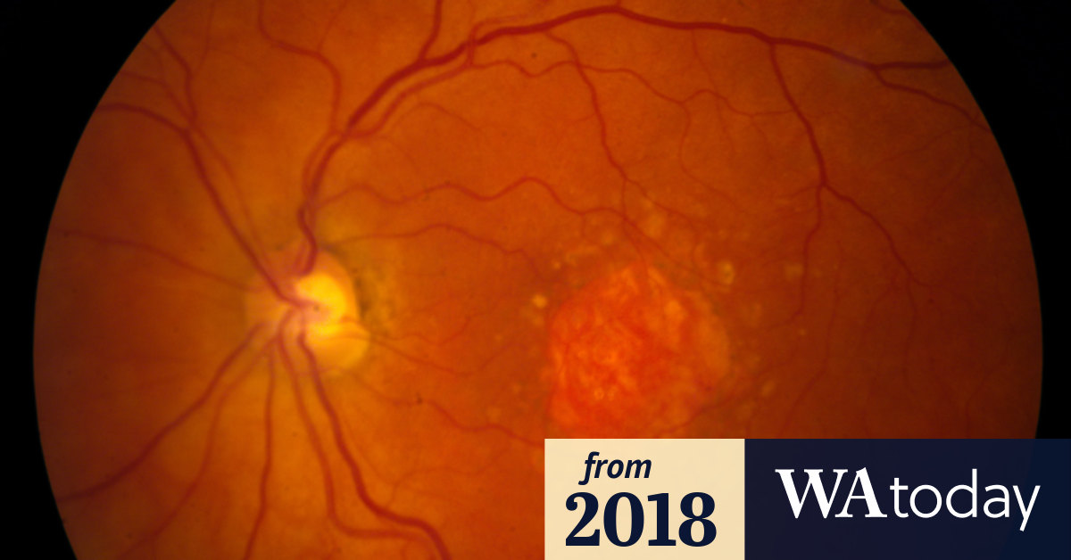 Dry macular degeneration treatment breakthroughs