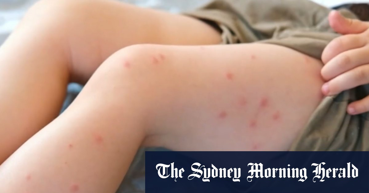 Measles cases spiking across Queensland