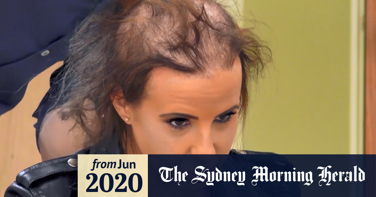 Video: Woman struggles with significant hair loss