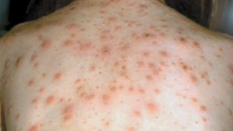 Rise in measles cases in Victoria