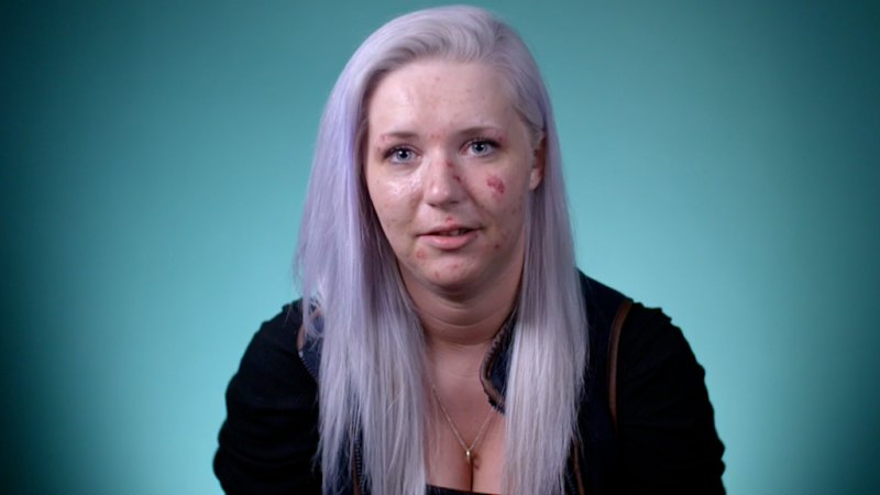Woman reveals severe skin condition makes her afraid to leave the house