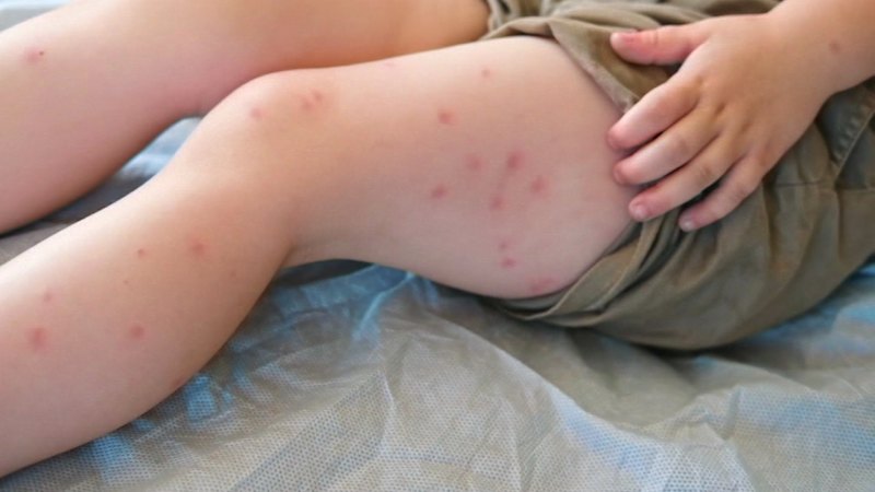 Measles outbreak spreads across South Australia