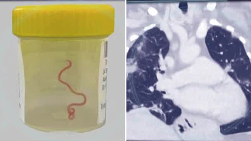 Live worm found inside Australian woman's brain