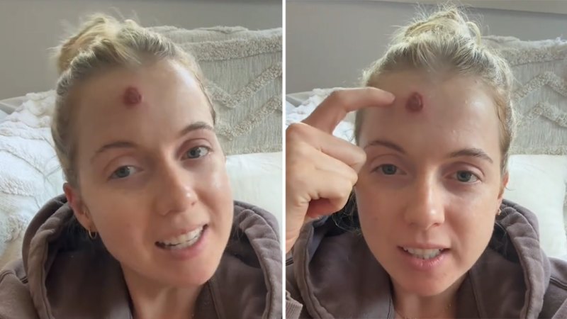 Melbourne mum reveals ‘pimple’ turned out to be skin cancer