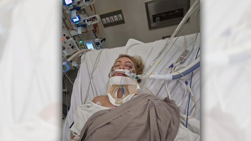 Mother fighting for life after Melbourne e-scooter hit and run