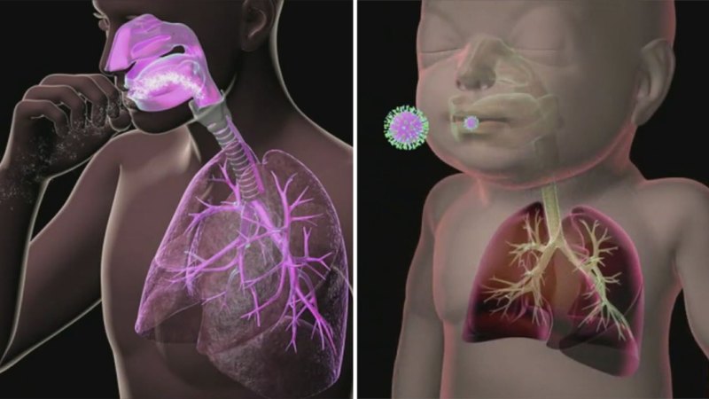 Cases of RSV surge across Australia