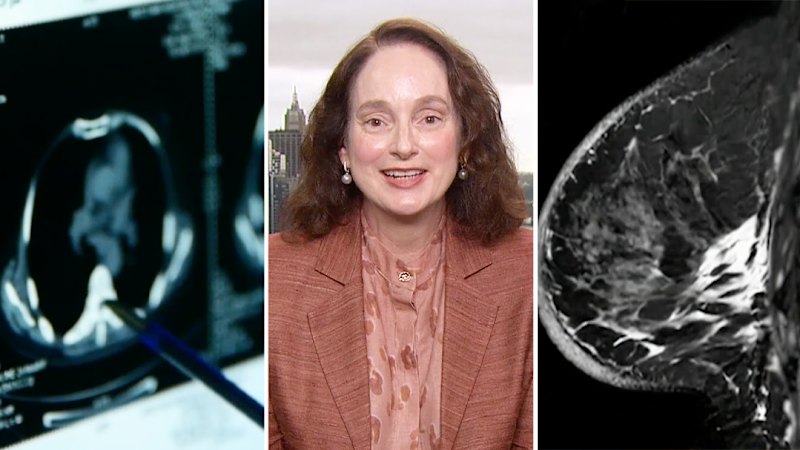 Artificial intelligence revolutionising breast cancer research