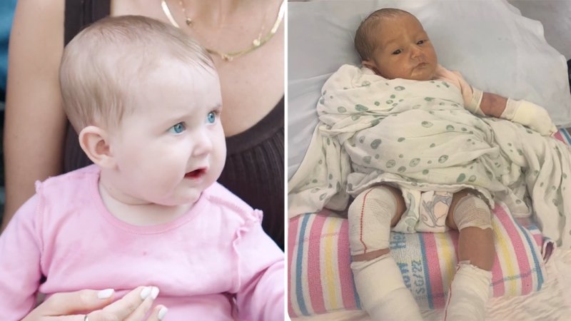 Baby Ella was born with a condition so rare only 1000 Aussies have it