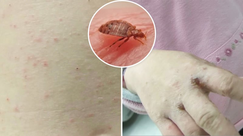 NSW residents warned of scabies outbreak