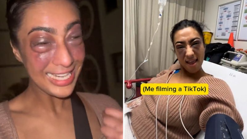 Influencer filmed a TikTok instead of going to the hospital for allergic reaction