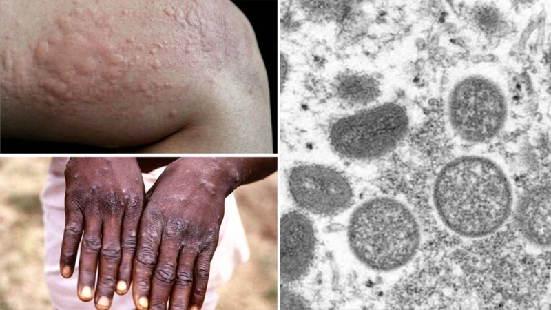 Africa declares public health emergency following Mpox outbreak