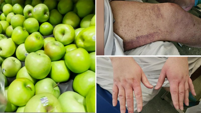 Man diagnosed with scurvy amid cost-of-living crisis