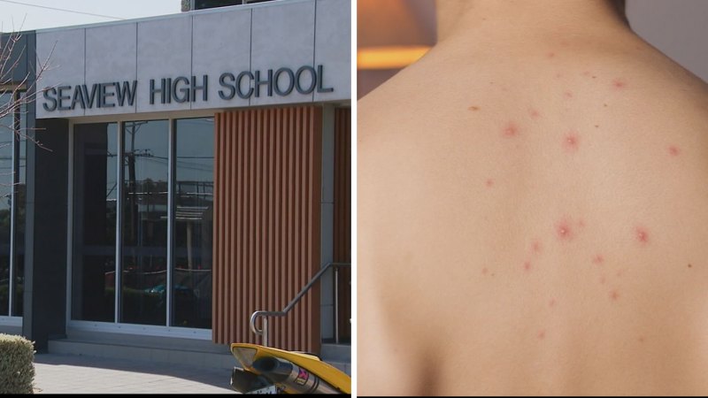 Adelaide hit with chicken pox outbreak