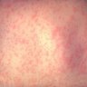 Measles alert for Brisbane's south and Logan