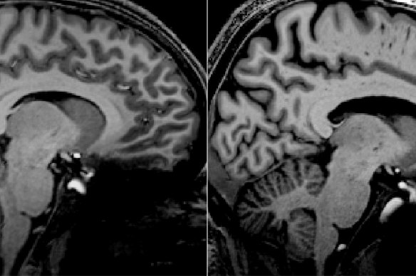 Detailed scans of a long-COVID patient (left) and an ME/CFS patient (right) show similar structures in the brain stem.