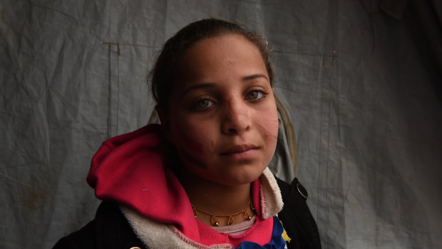 Ten-year-old Sabeen, from the suburb of Karama in Mosul was on her way to school when a car bomb killed her brother and injured her leaving scars on her face.