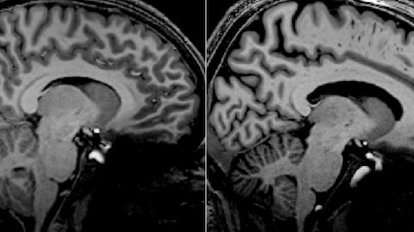Detailed scans of a long-COVID patient (left) and an ME/CFS patient (right) show similar structures in the brain stem.