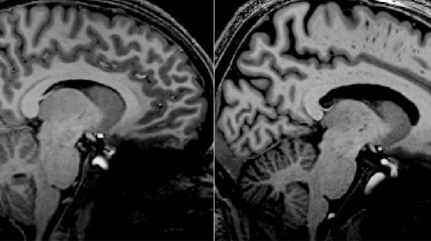 Detailed scans of a long-COVID patient (left) and an ME/CFS patient (right) show similar structures in the brain stem.