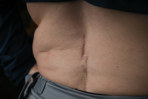 Lou Whelan shows the scarring from having two spinal cord stimulators implanted.