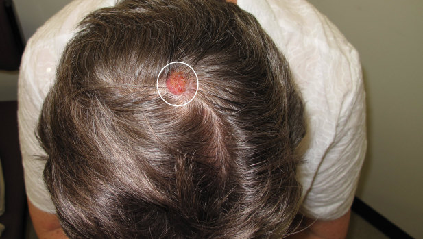 An example of melanoma.