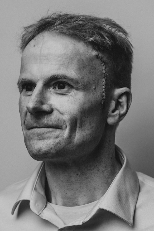 Professor Richard Scolyer after brain surgery.