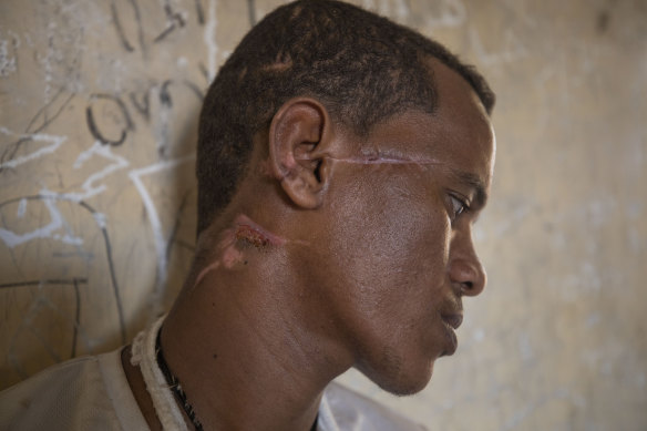 Machete scars criss-cross the face and neck of Tigrayan survivor Abrahaley Minasbo, 22. 