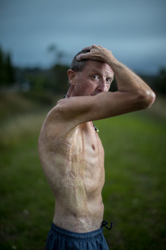 Former jockey Ron Lockett was “accidentally” set on fire as an apprentice in the 1970s.
