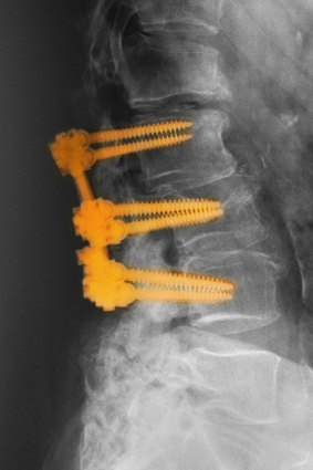 Spinal fusion involves the joining of two or more vertebrae. Maree Rivero had a two-level spinal fusion after complications with her back operation.