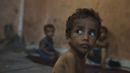 Yazan Abu Ful, a 2-year-old malnourished child, sits at his family home in the Shati refugee camp in Gaza City on July 23, 2025.