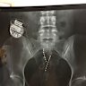 These spinal devices cost more than $50,000. A new study found they come with serious risks
