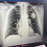 An X-ray of Fotis Kapetopoulos’ chest after he had a pacemaker installed.
