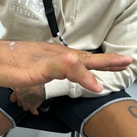 Josh Addo-Carr’s injured finger.