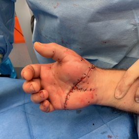 Lawrence Cooper's hand after it was reattached during a seven-hour surgery at Brisbane's Mater Private Hospital.