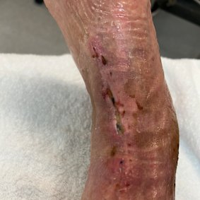 Wayne Rance’s injury in its early stages.