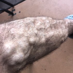 Photos taken months after the event show unexplained lumps on Mr Deliu's legs.