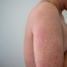 A measles warning has been issued for south-west WA.