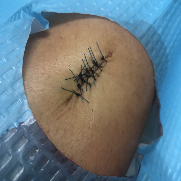 Stitches in Kate Thomas’ leg following the removal of a melanoma in 2020.