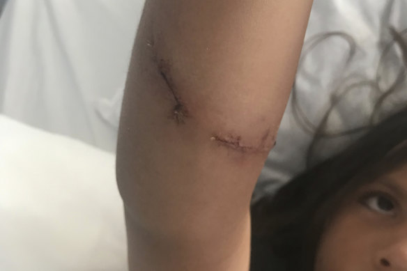Ella's surgery scar.