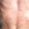Measles is often characterised by a rash that spreads across the body.
