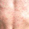 Measles is often characterised by a rash that spreads across the body.