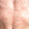 Measles is often characterised by a rash that spreads across the body.