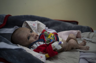 Mohammed, four months old, lies on a bed in the Indira Gandhi hospital in Kabul, Afghanistan on Monday.