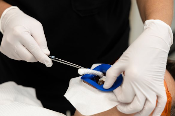 The gauze is removed from Jean Carre’s mouth when the whitening is finished.