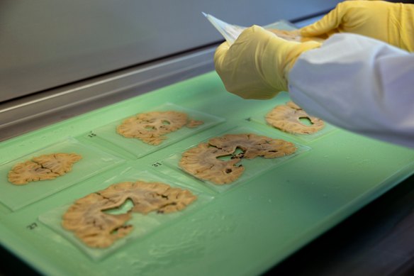 Dr Claire Shepherd examines brain tissues collected through the Sydney Brain Bank for CTE research.