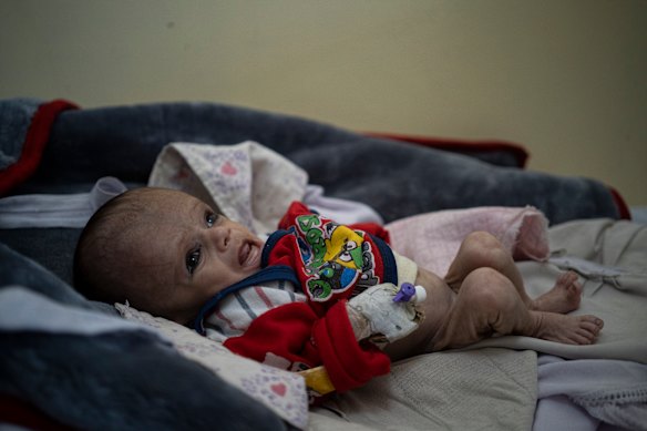 Mohammed, four months old, lies on a bed in the Indira Gandhi hospital in Kabul, Afghanistan on Monday.