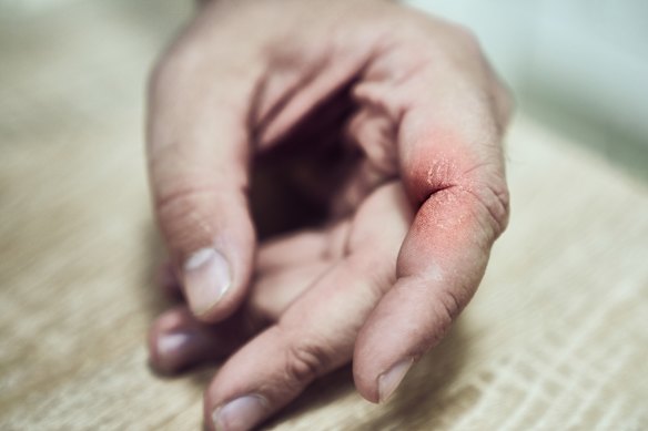 Neurodermatitis, psoriasis on the hand can be treated with a topical ointment, typically a corticosteroid prescribed by a dermatologist.