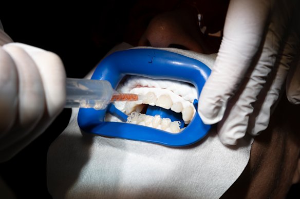 With the gums and mouth shielded, the active ingredient is applied: hydrogen peroxide. 