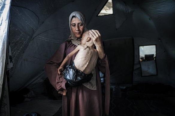Muhammad Zakariya Ayyoub al-Matouq, 1, is facing life-threatening malnutrition.