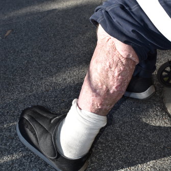 Meet Freddy (Krueger): Mr Basell’s leg after a flesh-eating infection caused by bed bugs.